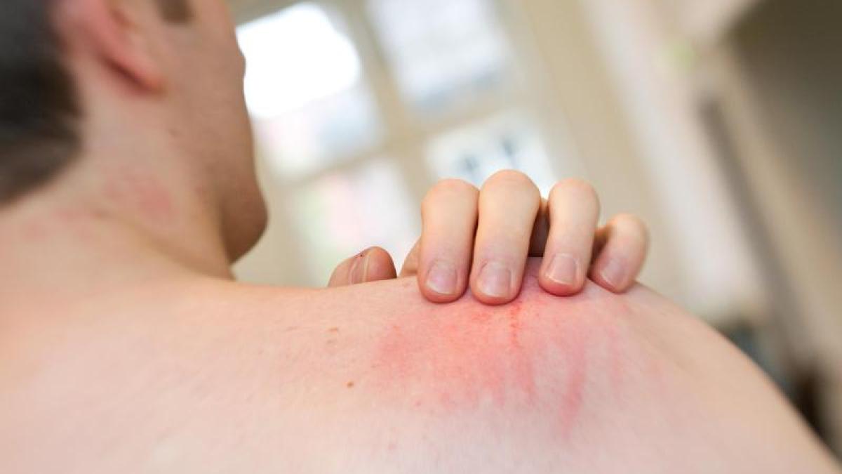 Health: Chronic itching in adults is increasing